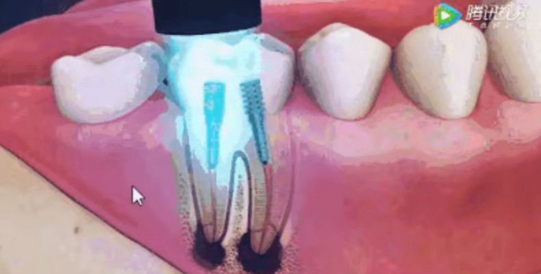 Why isn't root canal treatment completed in one session? Why isn't root canal treatment completed in one session?