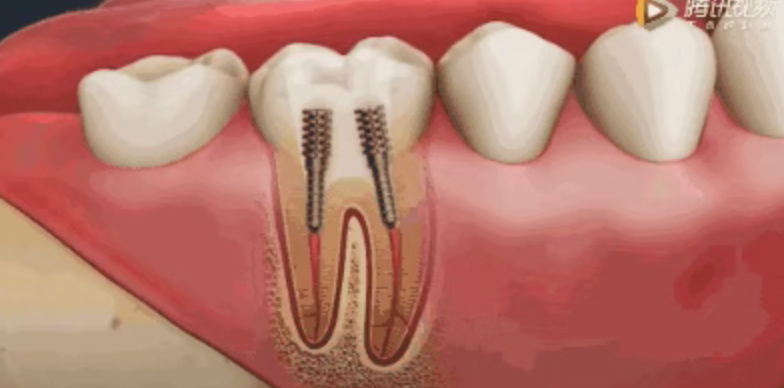 Why isn't root canal treatment completed in one session? Why isn't root canal treatment completed in one session?