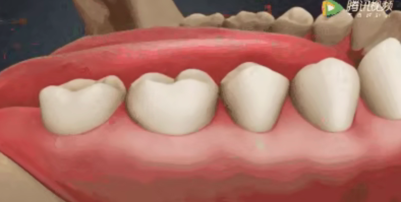 Why isn't root canal treatment completed in one session? Why isn't root canal treatment completed in one session?