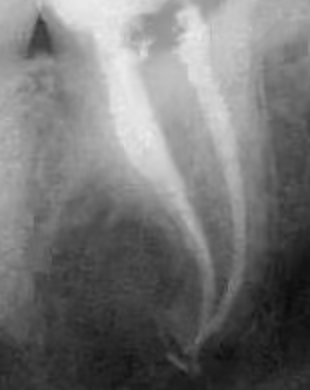 Why isn't root canal treatment completed in one session? Why isn't root canal treatment completed in one session?