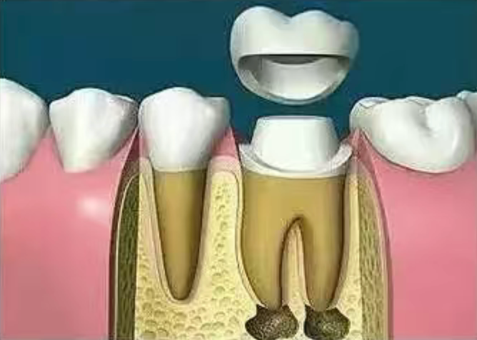 Why isn't root canal treatment completed in one session? Why isn't root canal treatment completed in one session?