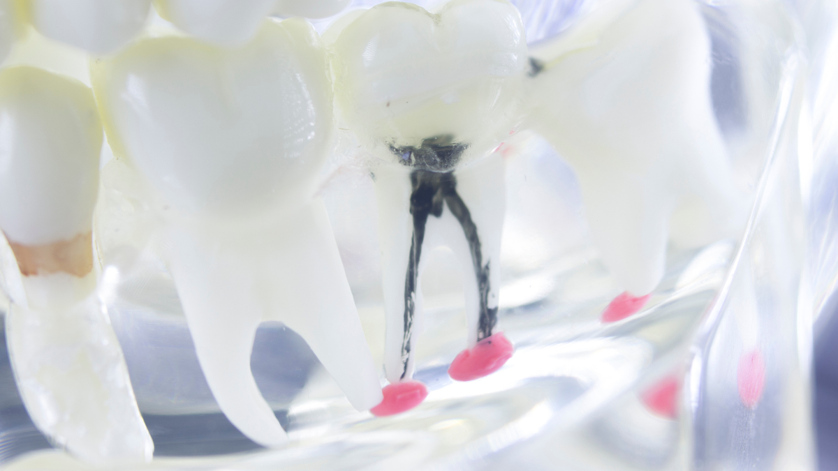 Why isn't root canal treatment completed in one session?