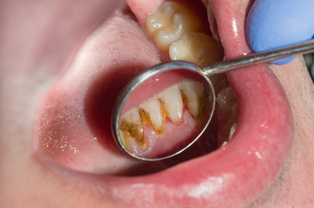 These daily habits gradually wear down your teeth These daily habits gradually wear down your teeth