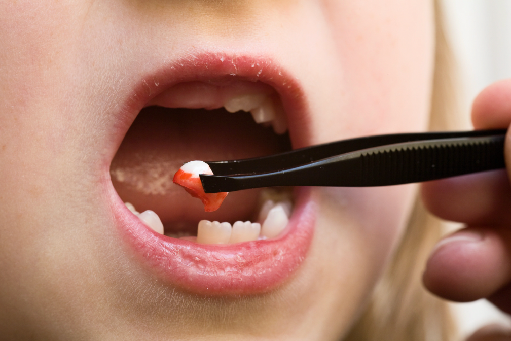 Tooth extraction notification Tooth extraction notification