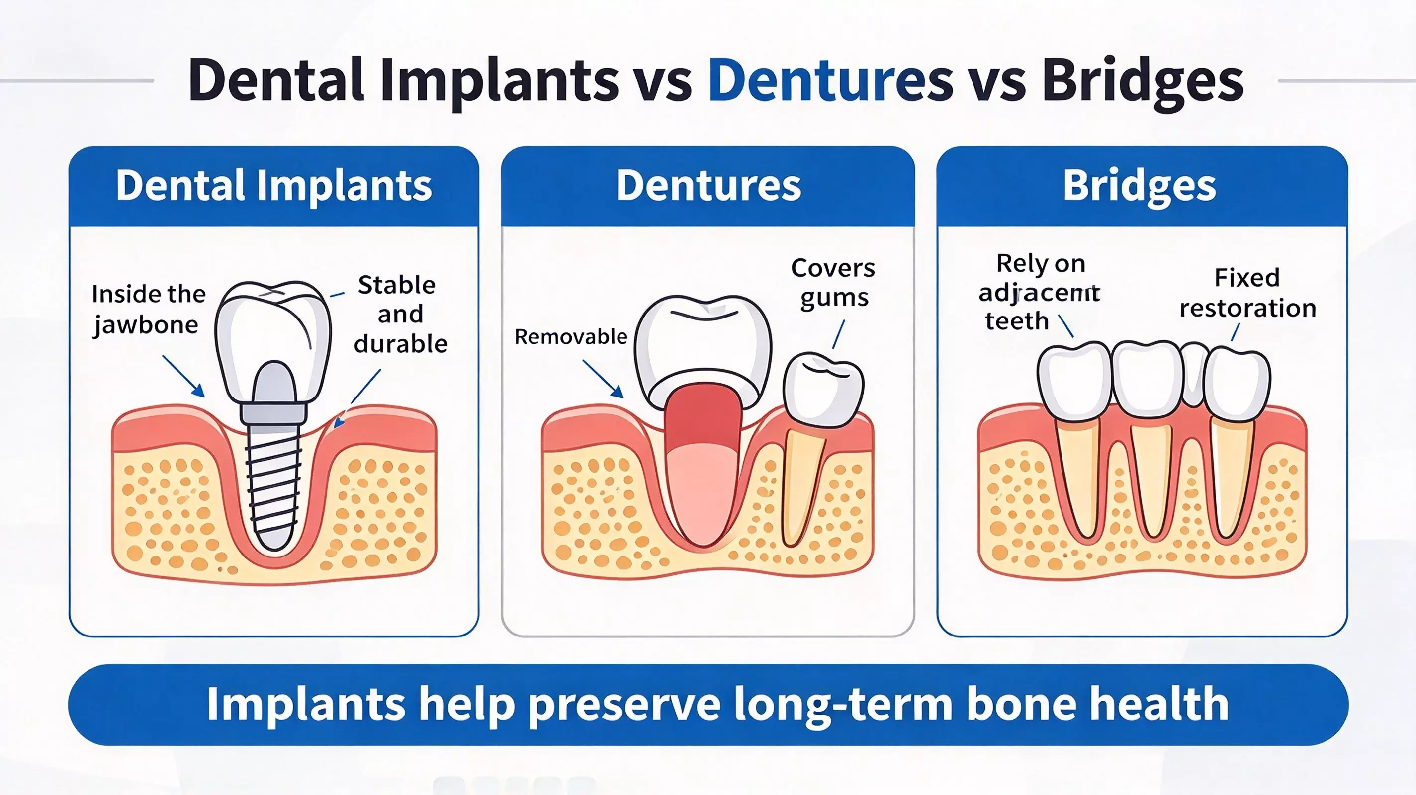What are dental implants? What are dental implants?